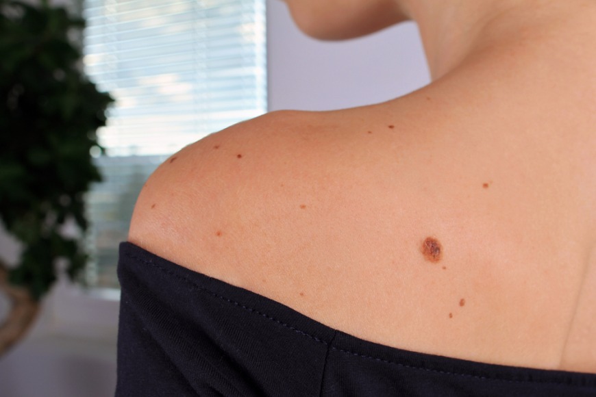 Birthmark treatment at Dr. Kamil Al Rustom Skin and Laser Centre Dubai Birthmark treatment at Dr. Kamil Al Rustom Skin and Laser Centre Dubai